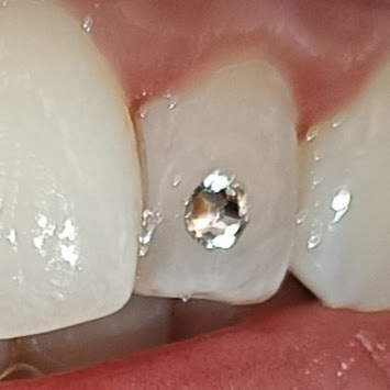Applicazione Gemme Dentali